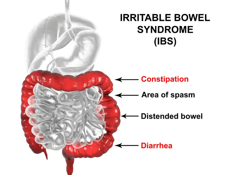 probiotici-ibs